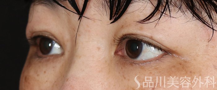 症例NO.71348のAFTER写真