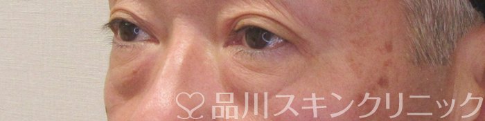症例NO.70679のBEFORE写真