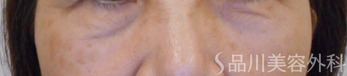 症例NO.71877のBEFORE写真