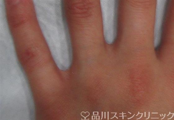 症例NO.25642のAFTER写真