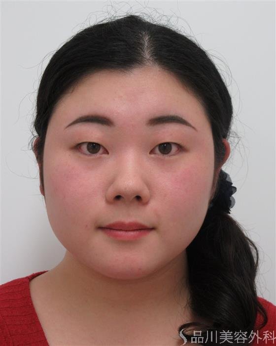 症例NO.26465のBEFORE写真