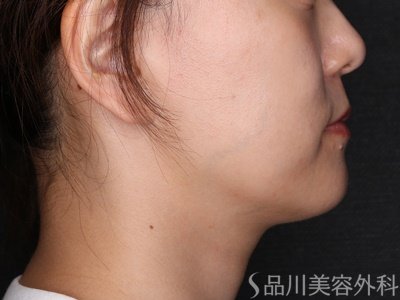 症例NO.71274のAFTER写真