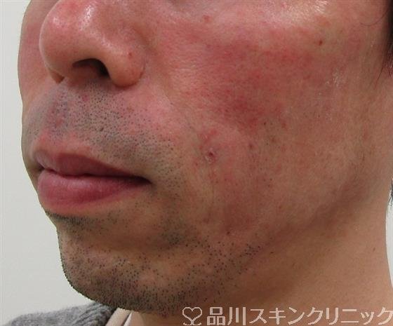 症例NO.33446のAFTER写真