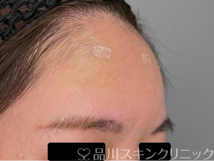症例NO.70091のAFTER写真