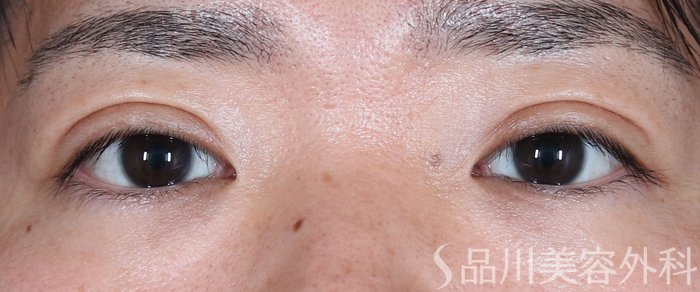 症例NO.74182のAFTER写真