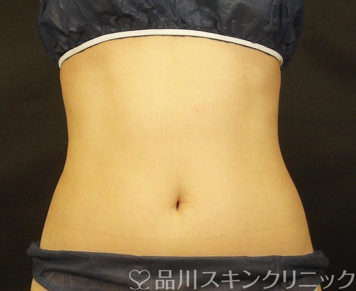 症例NO.67414のAFTER写真
