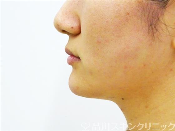 症例NO.51226のAFTER写真