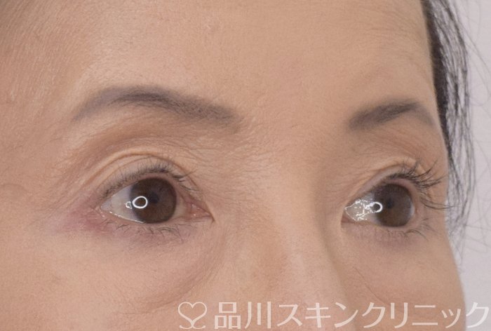 症例NO.69556のAFTER写真