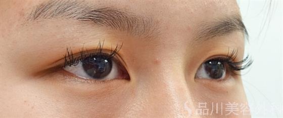 症例NO.34443のBEFORE写真