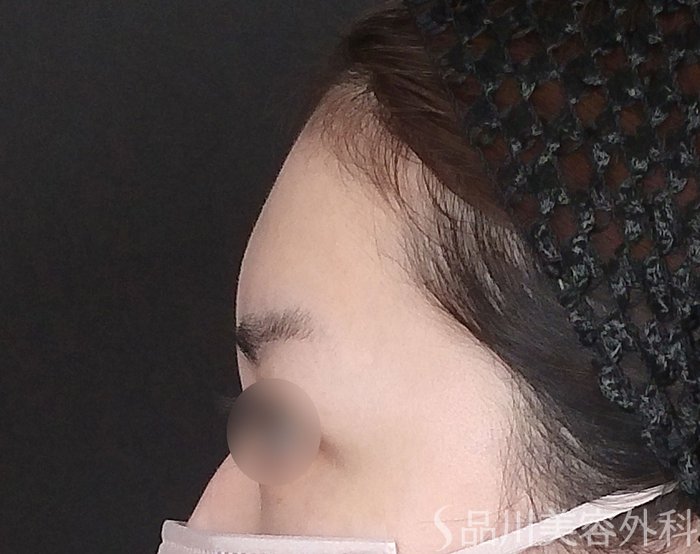 症例NO.67774のBEFORE写真