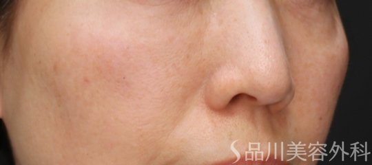 症例NO.73800のAFTER写真
