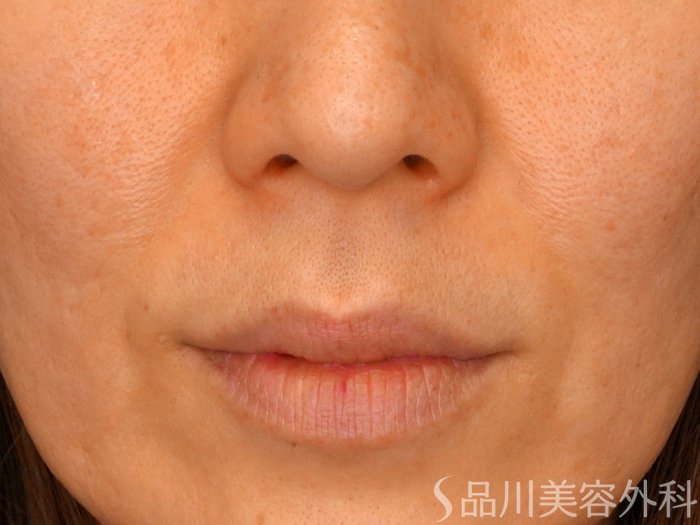 症例NO.67867のBEFORE写真