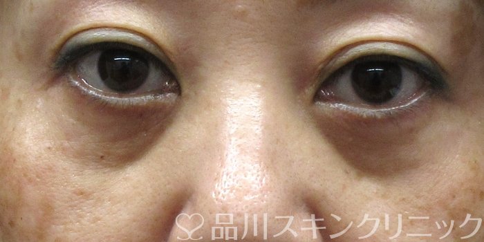 症例NO.74409のAFTER写真