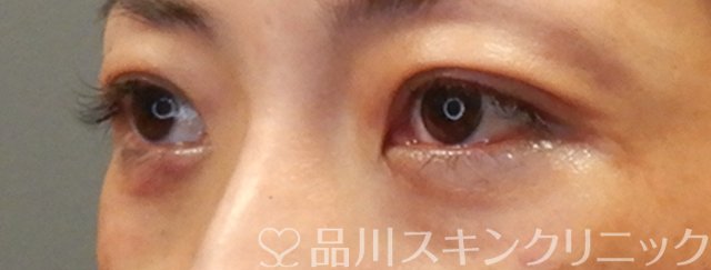 症例NO.66353のAFTER写真