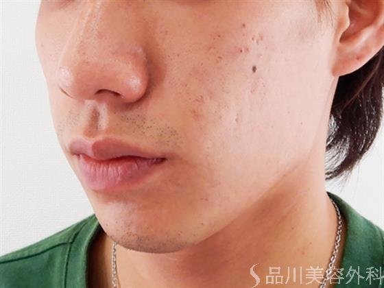 症例NO.60485のAFTER写真