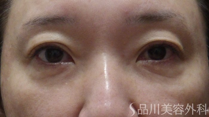 症例NO.72394のBEFORE写真