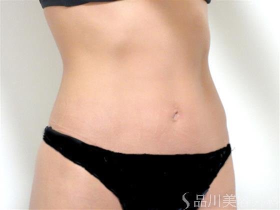 症例NO.27595のAFTER写真