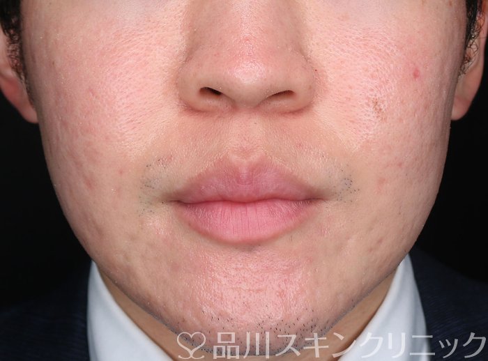 症例NO.74125のAFTER写真