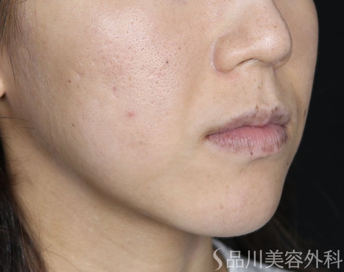 症例NO.72086のBEFORE写真