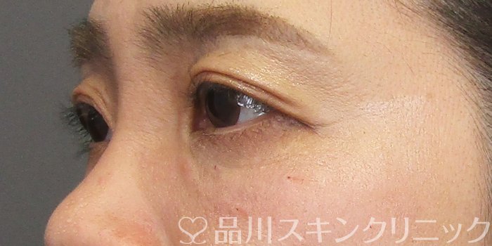 症例NO.75173のAFTER写真