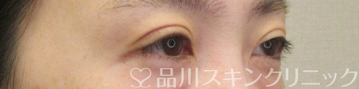 症例NO.74517のAFTER写真