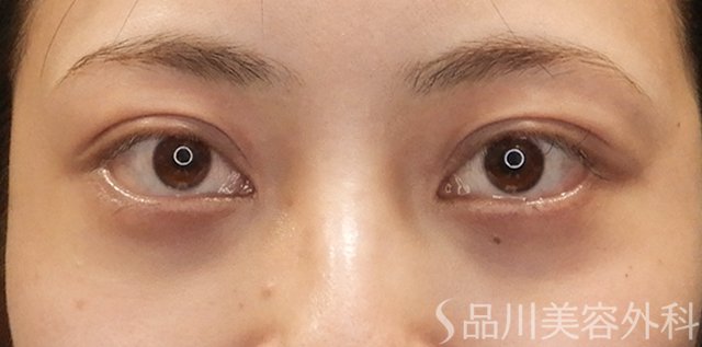 症例NO.74433のAFTER写真