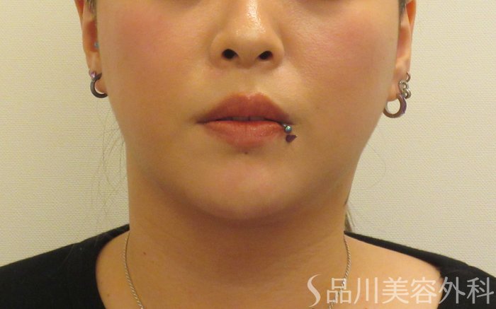 症例NO.71806のAFTER写真