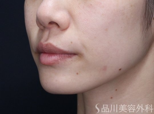 症例NO.73824のBEFORE写真