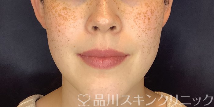 症例NO.69555のBEFORE写真