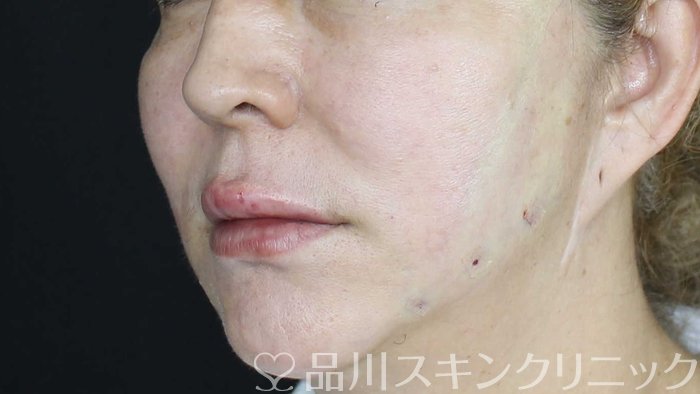 症例NO.72001のAFTER写真