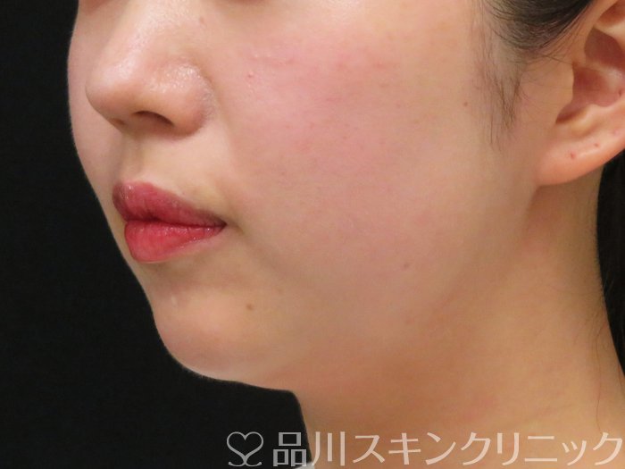 症例NO.65336のBEFORE写真