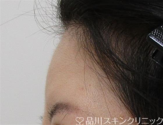 症例NO.42337のAFTER写真