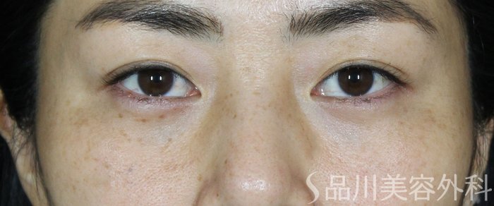 症例NO.62227のAFTER写真