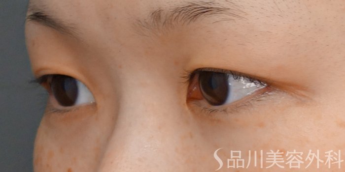 症例NO.70682のBEFORE写真