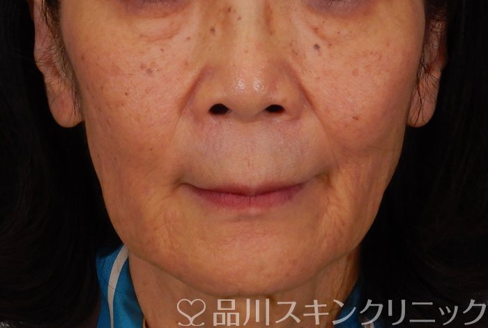 症例NO.65184のBEFORE写真