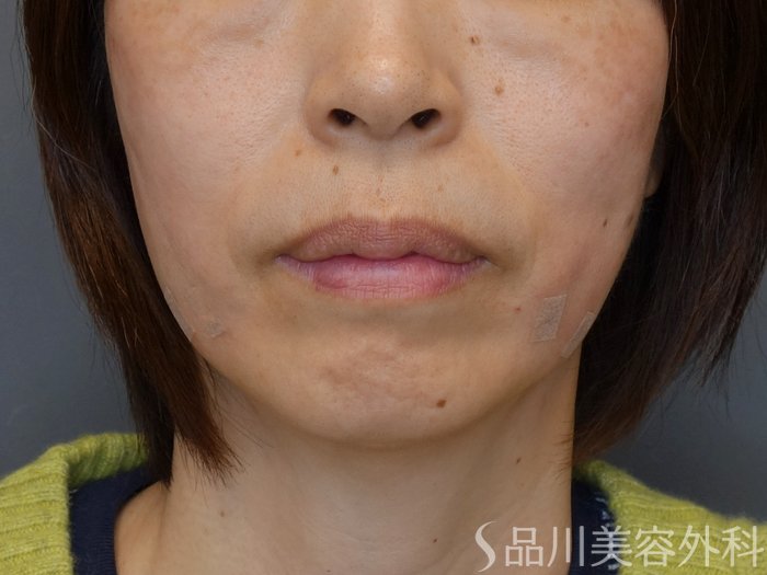 症例NO.72872のAFTER写真