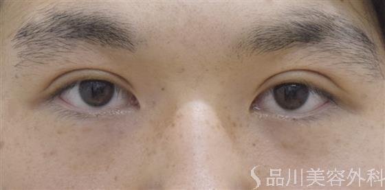 症例NO.52435のAFTER写真