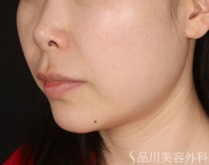 症例NO.73315のBEFORE写真