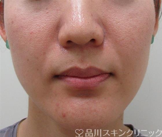 症例NO.32643のBEFORE写真