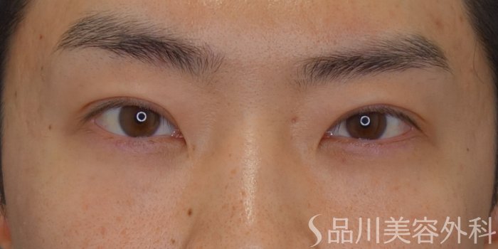 症例NO.74969のAFTER写真