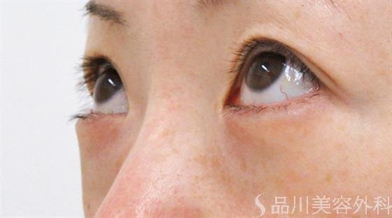 症例NO.22977のBEFORE写真