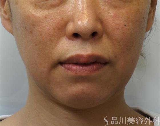 症例NO.40179のBEFORE写真
