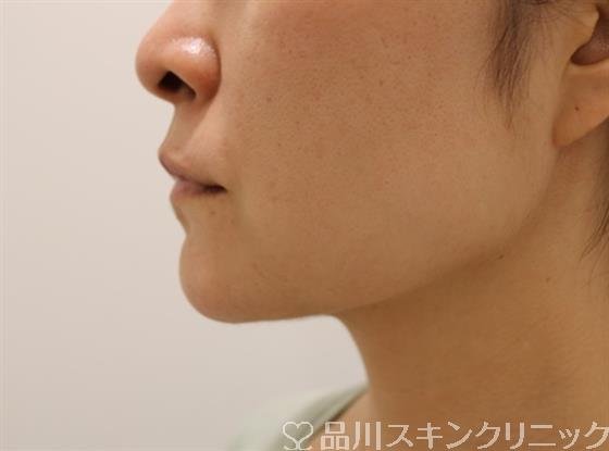 症例NO.42480のBEFORE写真