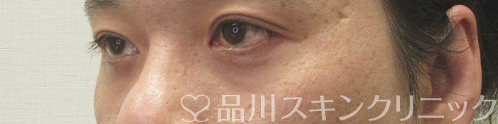 症例NO.71038のAFTER写真