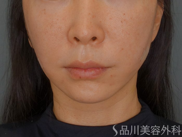 症例NO.74649のAFTER写真