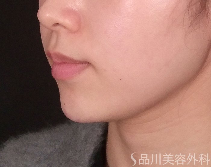 症例NO.69328のAFTER写真