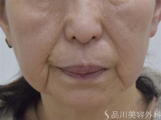 症例NO.51900のBEFORE写真