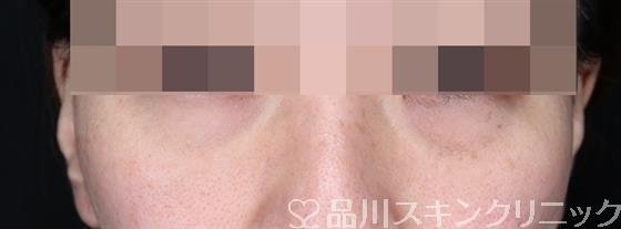 症例NO.54683のBEFORE写真