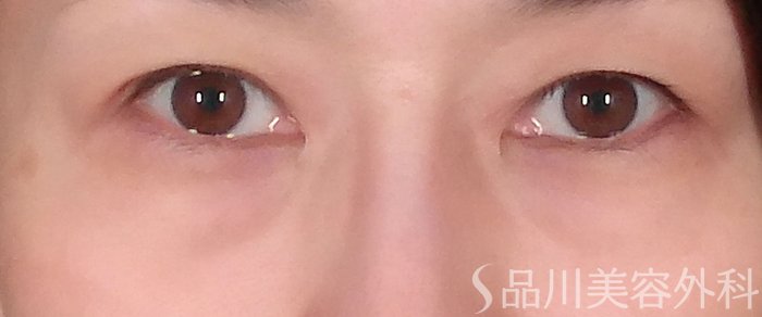 症例NO.70613のBEFORE写真