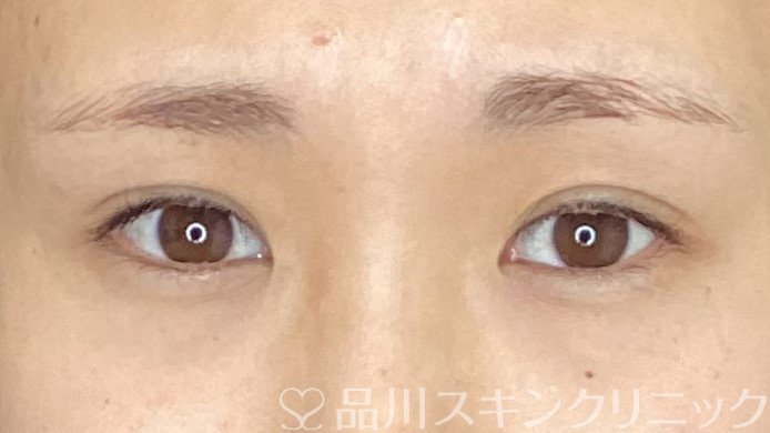 症例NO.67813のAFTER写真